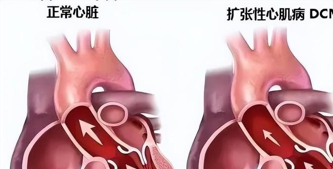 擴(kuò)心病最新治療藥品，希望之光照亮前行之路